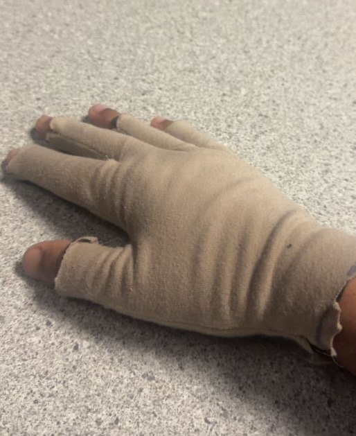 Eczema Occlusion Therapy Glove photo 1